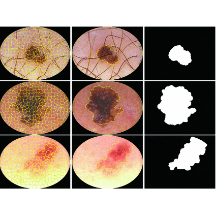 Automatic Skin Lesion Segmentation on Dermoscopic Images by the Means of Superpixel Merging