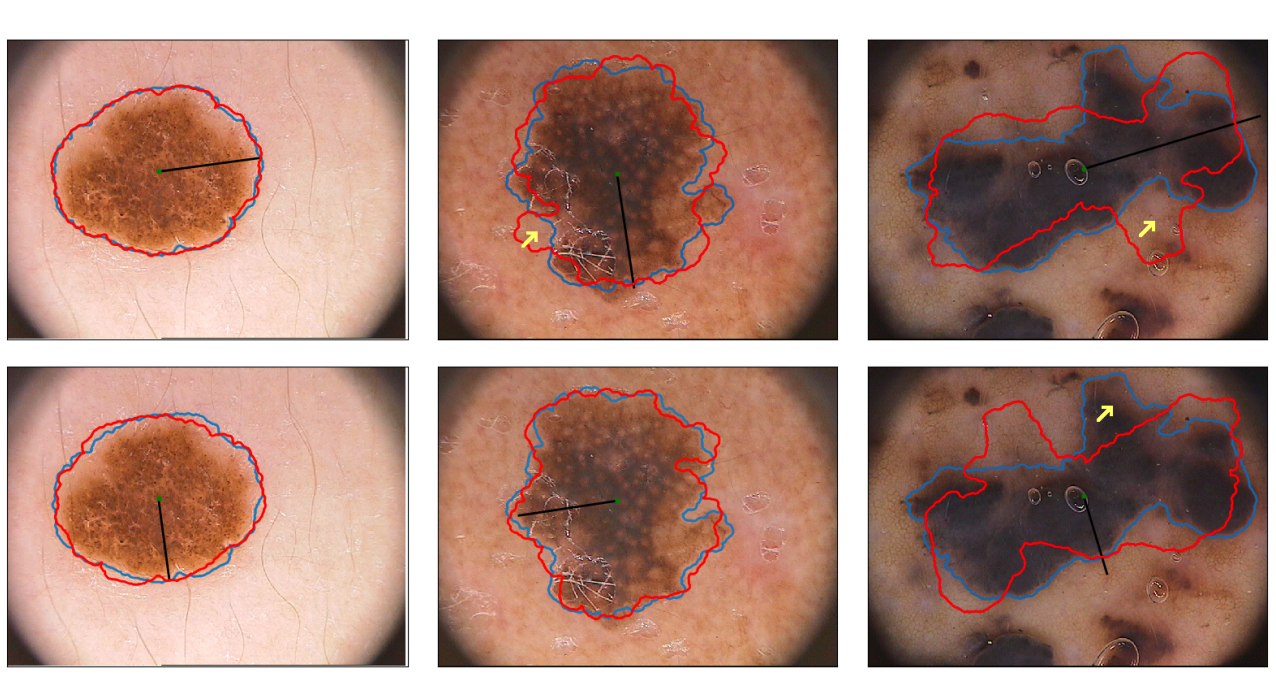 Melanoma detection on dermoscopic images using superpixels segmentation and shape-based features